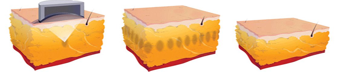 Loposonix, Aparato para Adelgazar Liposonix